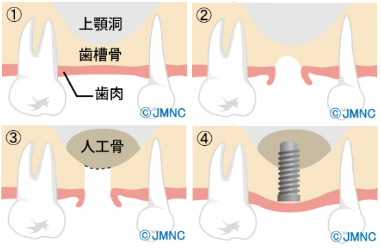 骨が薄い・骨が足りない場合の「インプラント治療」
