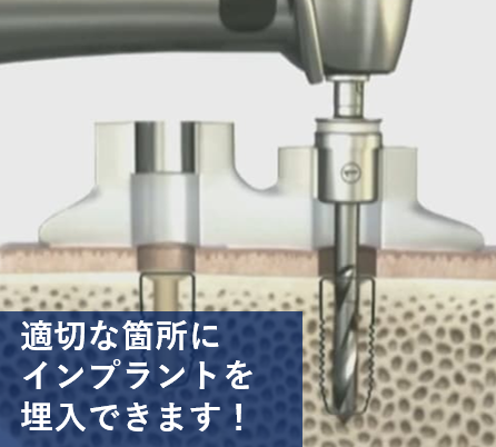 インプラントを正確な位置に埋入するための「サージカルガイド」