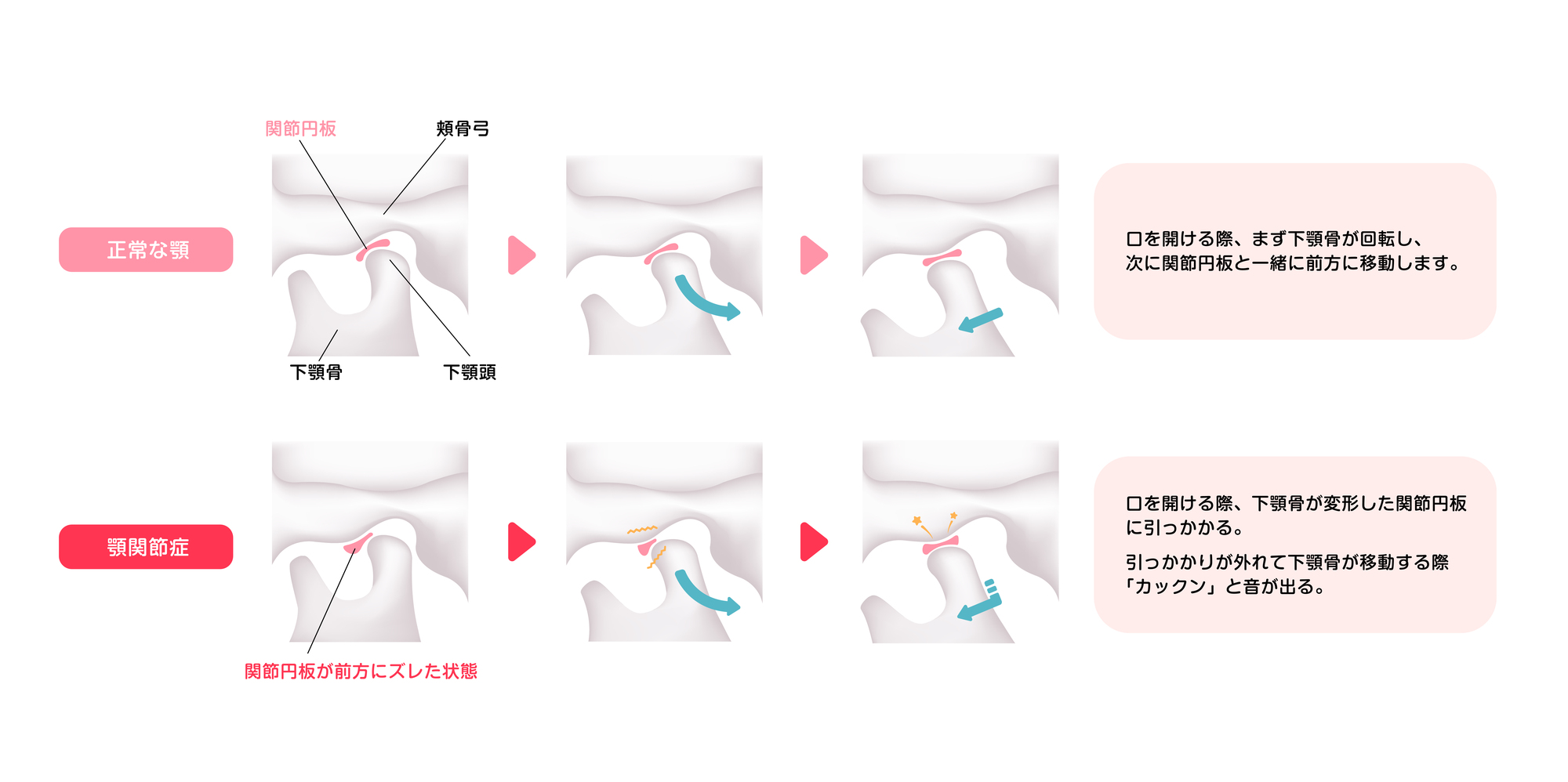 顎関節症
